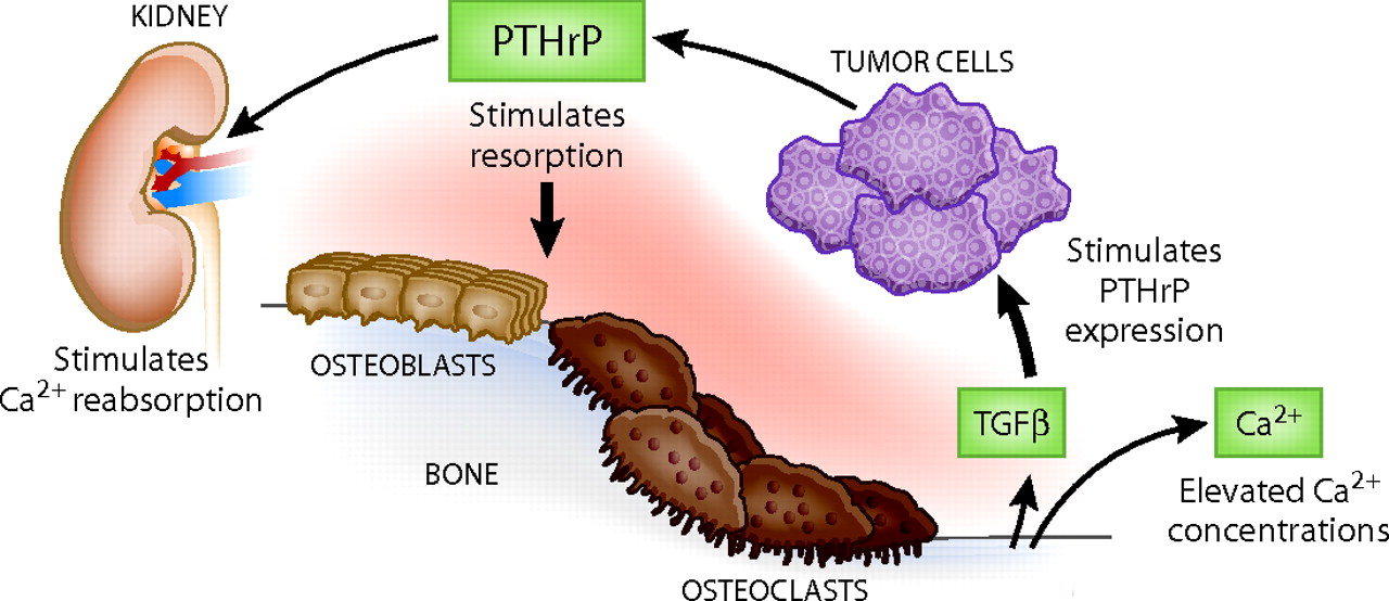 Hypercalcemia And Malignancy Mechanism Medicine Specifics