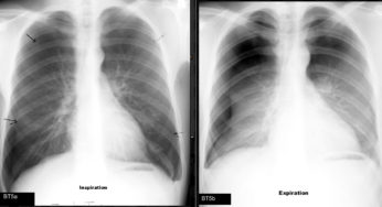Why expiration film for Pneumothorax?