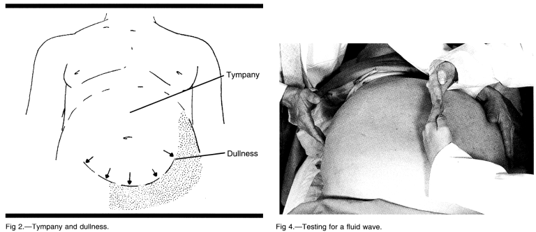 Ascites Fluid Wave Test: Why a hand on the abdomen? | Medicine Specifics