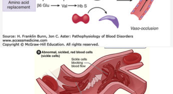 Sickle Cell Anemia Occlusion: Mechanism