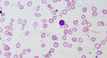 Blood test (Iron Studies) results of Iron Deficiency Anemia