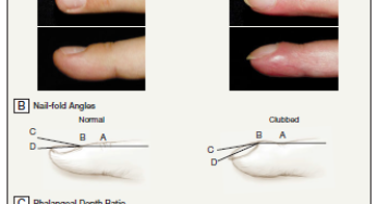 How to Assess for Nail Clubbing (JAMA)