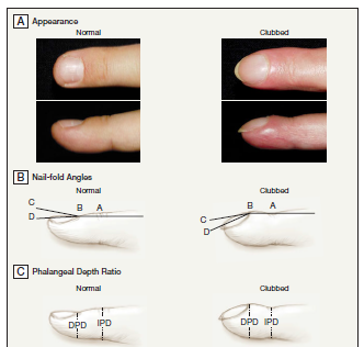 How to Assess for Nail Clubbing (JAMA) | Medicine Specifics