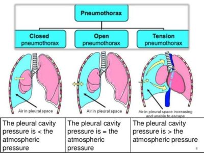 Spontaneous vs. Tension Pneumothorax