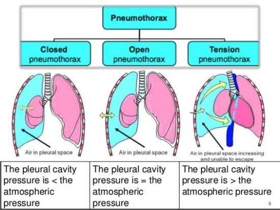 Spontaneous vs. Tension Pneumothorax