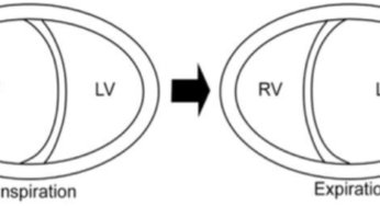 What is Ventricular interdependence?