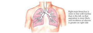 Lung lobes most commonly affected by Aspiration (Upright vs. Supine ...