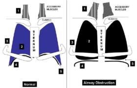 What is Hoover Sign? | Medicine Specifics