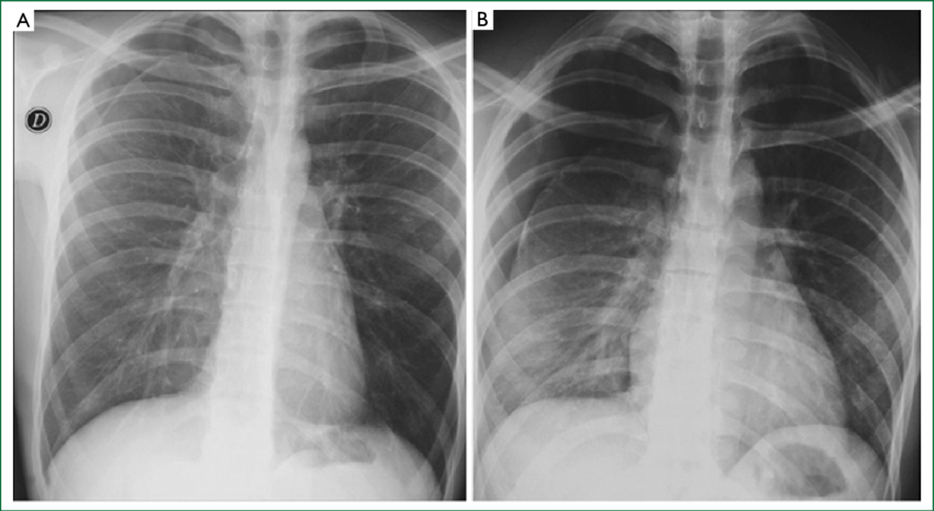 Why is high flow Oxygen used to resolve Pneumothorax?