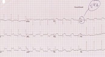 Why no Nitrates in Right Ventricle Myocardial Infarction (MI)?