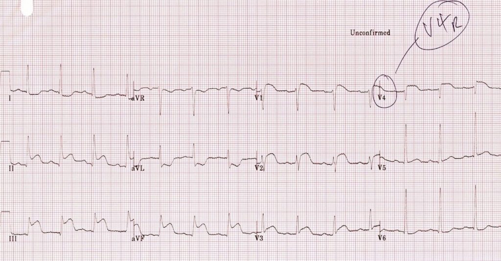 why-no-nitrates-in-right-ventricle-myocardial-infarction-mi