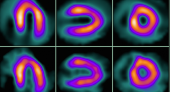 Myocardial Perfusion Imaging: Mechanism