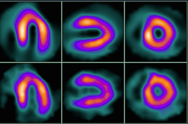 What Is Sestamibi Myocardial Perfusion Scan