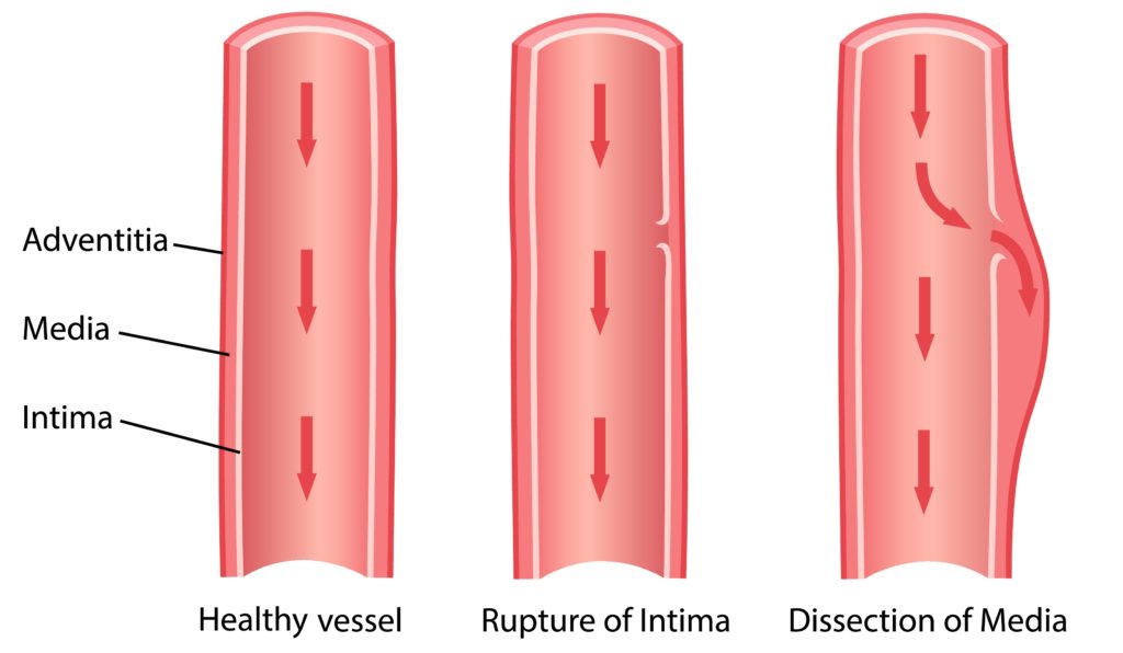 JAMA- Aortic Dissection [Likelihood Ratios] | Medicine Specifics