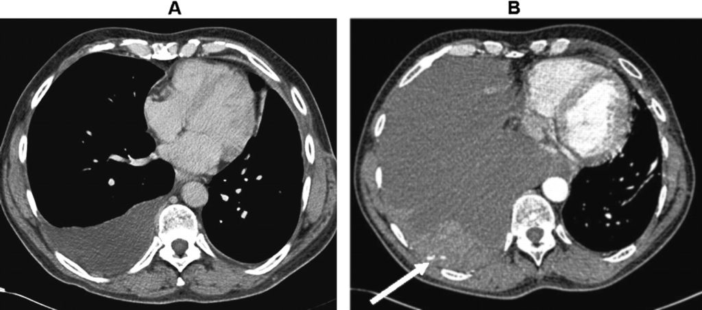 why-is-ldh-elevated-in-pleural-fluid-from-diuretics-mechanism